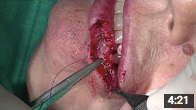 Carcinoma Spinocellulare Labbro inferiore