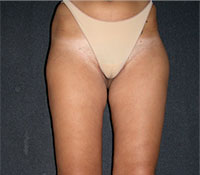 Liposuzione donna Dopo
