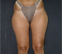 Liposuzione donna Prima